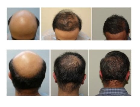 Hair follicle cloning or hair cell cloning trials have yet to become scientific reality