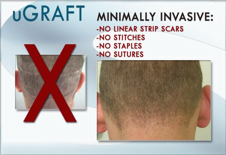 No Linear Scar Follicular Unit Extraction FUE Hair Transplant Services In Los Angeles