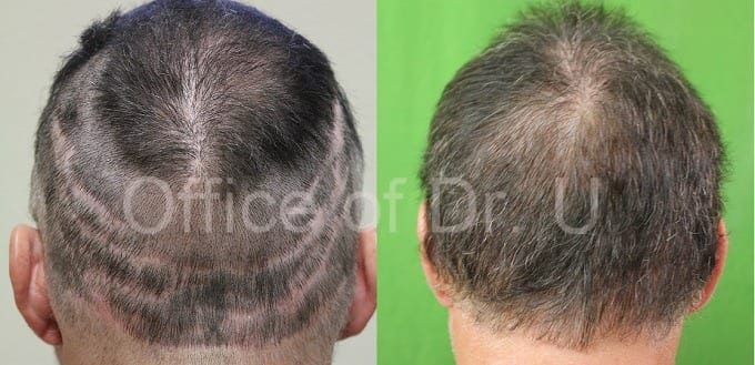 Before and after Dr.UGraft treatment for scars from previous surgeries
