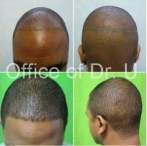With the advanced FUE by Dr.UGraft patients see real results. With the advanced FUE by Dr.UGraft patients see real results.