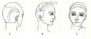Strip surgery is known for disastrous results. Strip surgery is known for disastrous results.