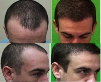 The advanced FUE method has many patients turning to hair transplants for natural looking results. The advanced FUE method has many patients turning to hair transplants for natural looking results.
