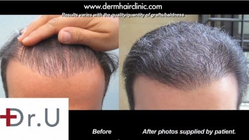Body hair transplantation with the advanced FUE by Dr.UGraft Body hair transplantation with the advanced FUE by Dr.UGraft