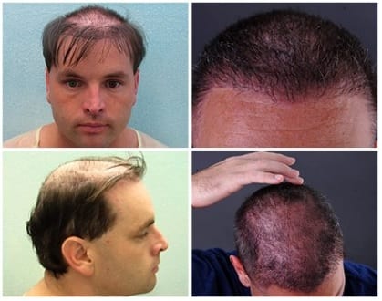 Before seeing Dr. Umar, the patient suffered complications of hair replacement. Before seeing Dr. Umar, the patient suffered complications of hair replacement.
