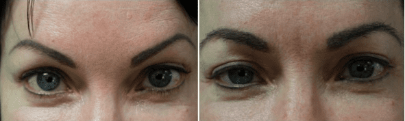 Eyebrow hair restoration: a breakthrough of.Dr.UGraft Eyebrow hair restoration: a breakthrough of Dr.UGraft