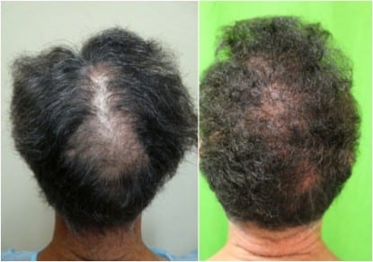 Crown Slot deformity caused by scalp reduction before and after photo, the area is covered using body hair by Dr.UGraft. Crown Slot deformity caused by scalp reduction before and after photo, the area is covered using body hair by Dr.UGraft.