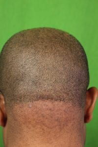 An early-stage AKN bump in the back of head treatment with laser result after two years