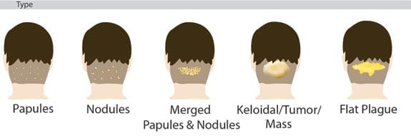 How to get rid of bumps on back of head by surgery? Acne keloidalis nuchae removal surgery is advised with merged papules & nodules.*