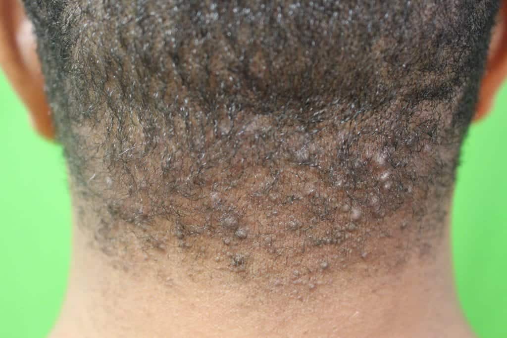 Pre-treatment with painful bumps on back of head laser cure