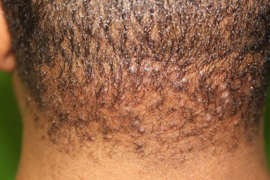 The appearance of acne keloidalis nuchae bumps on the back of the head can sometimes look like razor bumps on the back of the head.* The appearance of acne keloidalis nuchae bumps on the back of the head can sometimes look like razor bumps on the back of the head.*