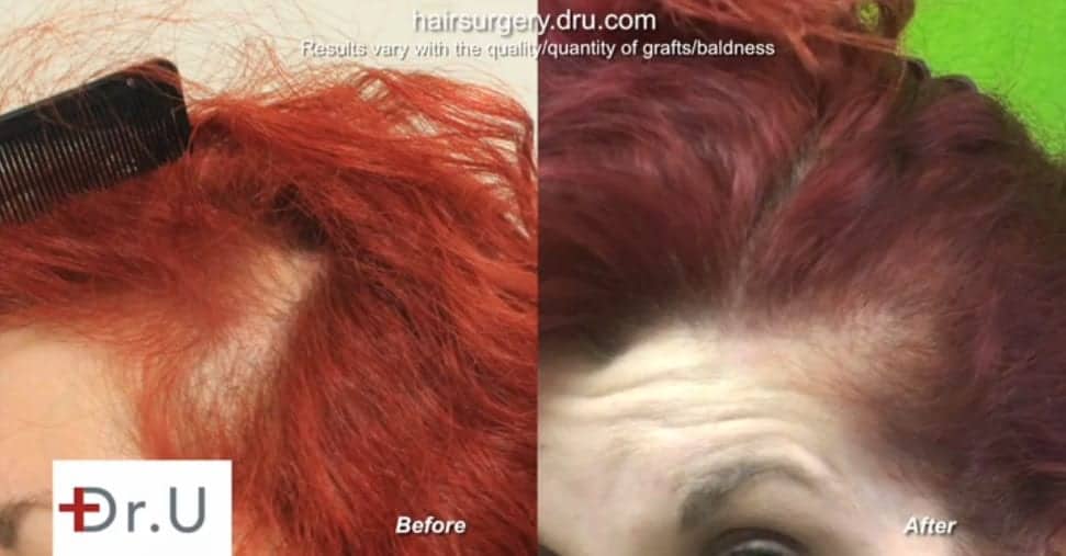 There are no more signs of female hair loss at temples for this patient.