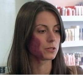 What is a V Beam Laser? A vascular laser can be used to treat a variety of skin conditions, even drastic ones such as this port-wine birthmark.