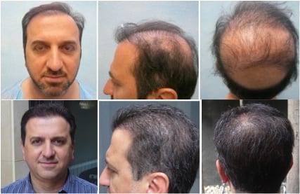 Hair replacement surgery: Before and after transformation by Dr.UGraft Hair replacement surgery: Before and after transformation by Dr.UGraft