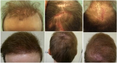 Before finding repair and hope from Dr U in Los Angles California who used Dr.UGraft hair transplant repair to fix him, this California patient began is hair restoration journey with a hair transplant tourism journey with a clinic abroad Before finding repair and hope from Dr U in Los Angles California who used Dr.UGraft hair transplant repair to fix him, this California patient began is hair restoration journey with a hair transplant tourism journey with a clinic in Canada