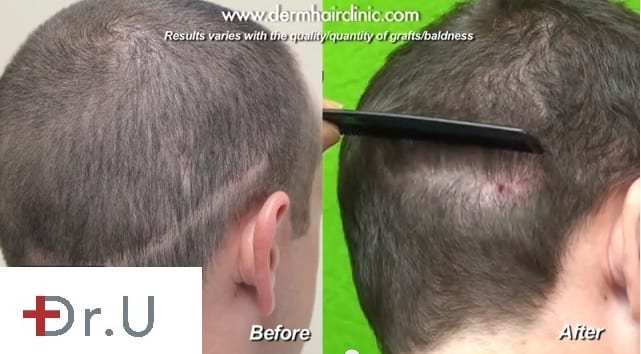 With the help of Dr. Umar's advanced FUE by Dr.UGraft method, this only shows full coverage and no visible scarring. With the help of Dr. Umar's advanced FUE by Dr.UGraft method, this only shows full coverage and no visible scarring.