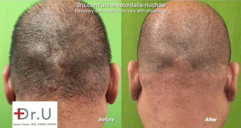 This patient saw the painful bumps on the back of his head disappear after five AKN laser treatments.