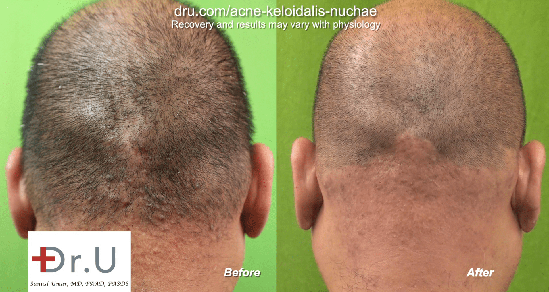 Laser Treatment