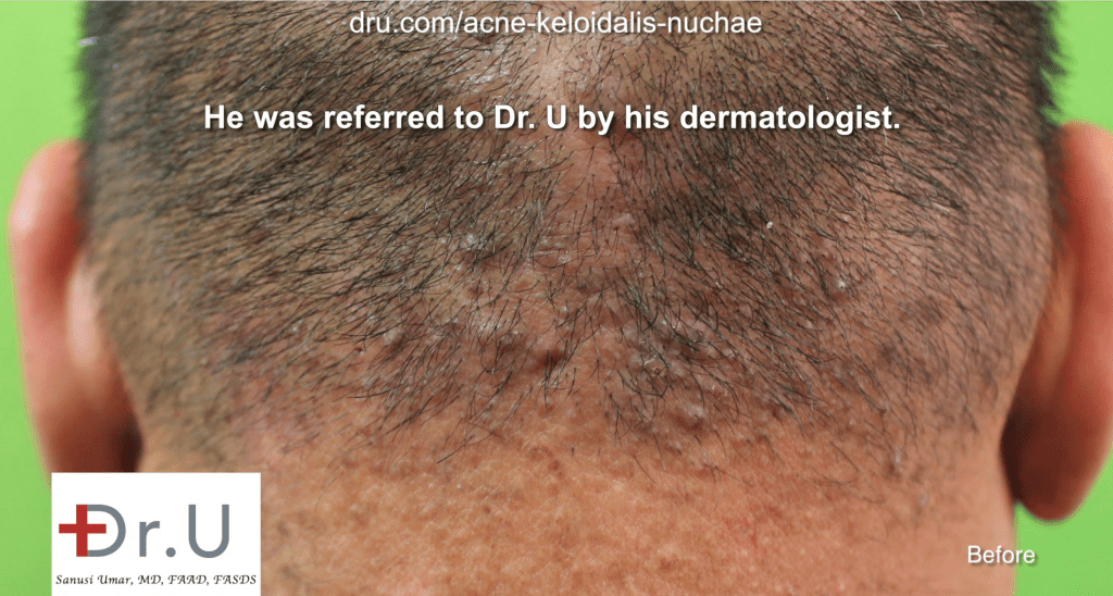 An example of how Acne Keloidalis Nuchae or AKN can manifest on an individual's scalp.* An example of how Acne Keloidalis Nuchae or AKN can manifest on an individual's scalp.*