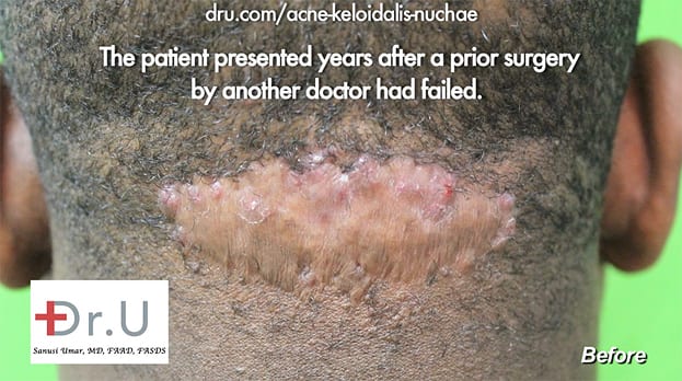 An example of AKN bumps on the back of the head and neck forming a large, single lesion.* An example of AKN bumps on the back of the head and neck forming a large, single lesion.*