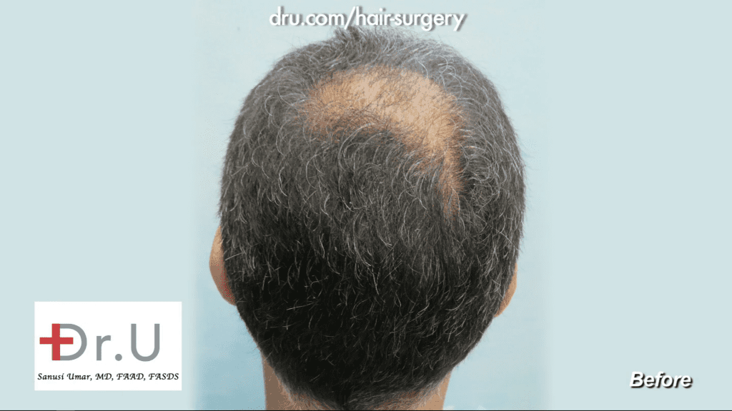 Crown baldness restoration - Before. You can see that it is localized to this specific spot. This patient experienced balding on the crown of his head, which was very visible from behind.