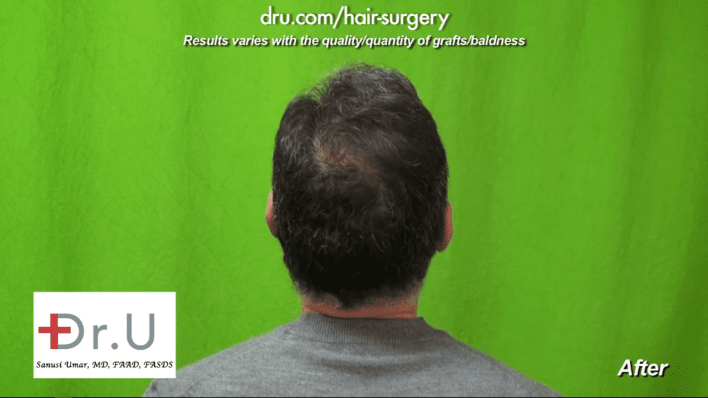 The patient's previous crown baldness isn't visible two years after his crown baldness FUE hair transplant using 1200 UGrafts. The patient's previous crown baldness isn't visible following Crown Baldness Restoration using Dr.UGraft FUE. Dr. Umar used 1200 DrUGrafts to treat the patient.