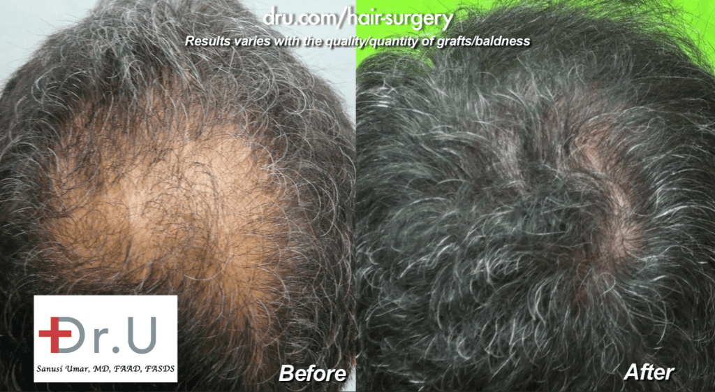 Dr. Umar extracted 1200 DrUGrafts from other areas of the scalp for this patient's crown baldness restoration with DrUGraft FUE. Dr. Umar extracted 1200 DrUGrafts from other areas of the scalp for this patient's crown baldness restoration with DrUGraft FUE.