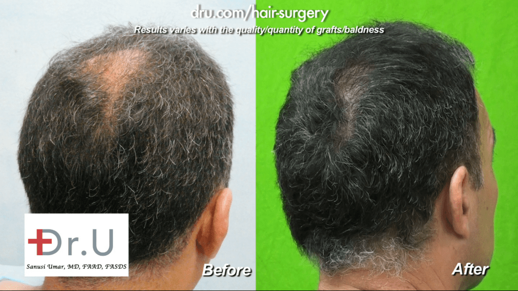 Crown baldness restoration: before and after photos Crown baldness restoration: before and after photos