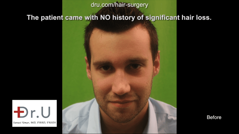 Dr.UGraft FUE Forehead Reduction by Hairline Using 3200 Grafts - Before