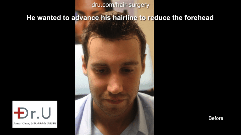 The patient wanted his hairline to cover more of the forehead and stronger temple points to match his new hairline.