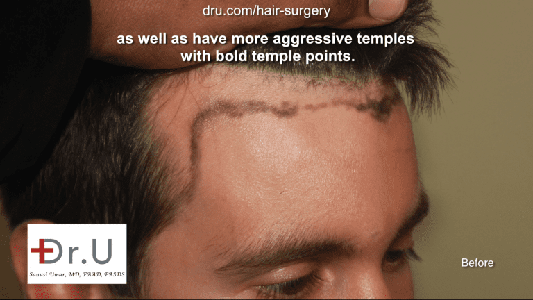 Hairline temple closure - Forehead reduction hairline transplantation