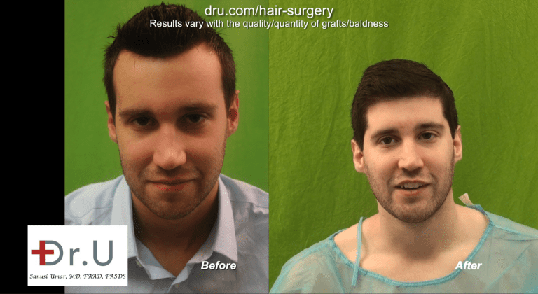 Before and After - FUE Forehead Reduction with DrUGraft