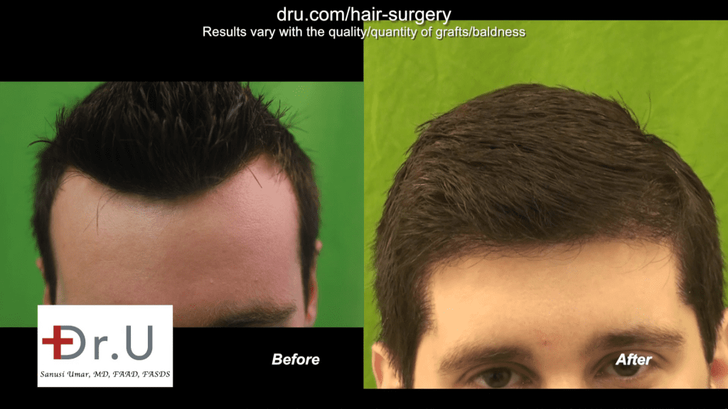 A patient's hairline appears more natural after undergoing the DrUGraft procedure at the best hair transplant clinic in the world