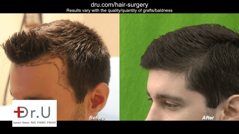 Profile Before and After Image - Norwood 1 FUE Hairline Transplant Forehead Size Reduction 