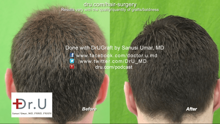 Back of Head Before and After Image - FUE Hairline Transplant Forehead Size Reduction Using 3200 Grafts