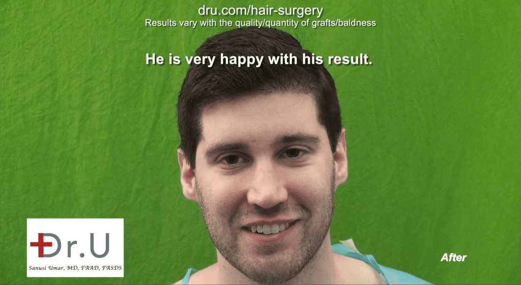 Patient Result Photo - Dr.UGraft Norwood 1 Forehead Size Reduction Hair Transplantation 