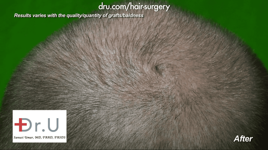 Dr. Umar matched the swirl pattern here while simultaneously improving the density of the hair already present. These DrUGrafts came from other areas of the head. 