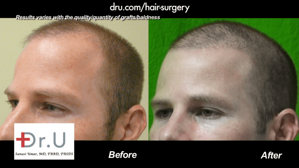 What is the best haircut after a less is more hair transplant?: This patient along with many others decided to sport a short buzz cut.