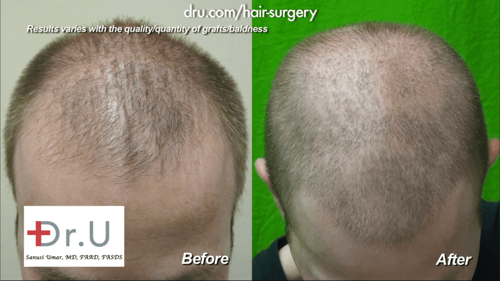 The patient's hair was evened out to create a more even distribution along the scalp. Note the areas of thinning along the temples have been improved dramatically. 
