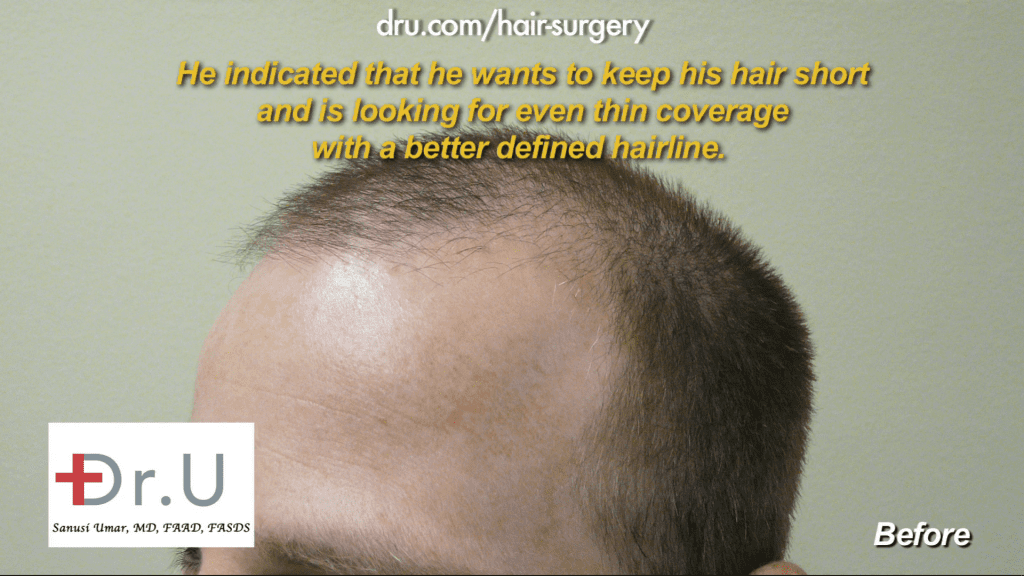 Patient wanted to know how to reduce hair transplant cost by less is more approach