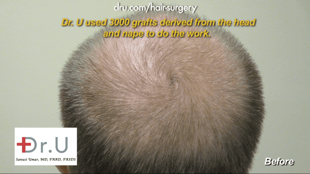This patient's thinning hair is uneven. By using grafts from other areas of the head, Dr. Umar aimed to even out the patient's hair along the scalp. 