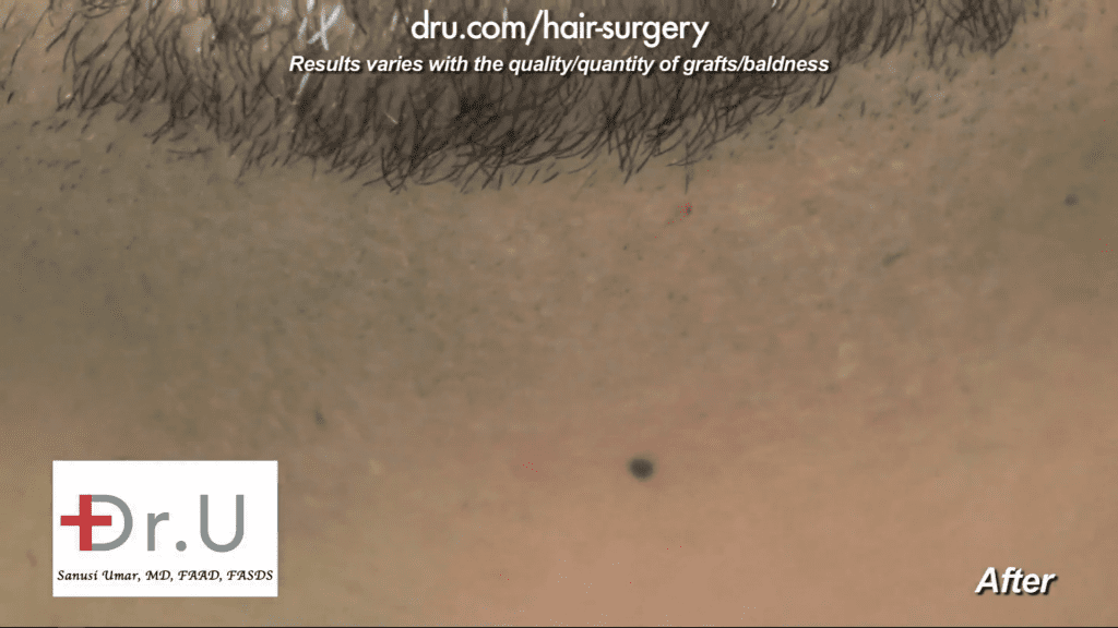 The patient's donor area, post-surgery.