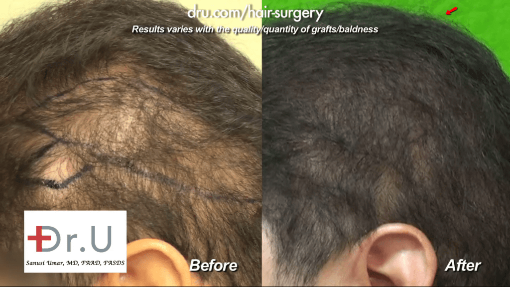 Hair transplant donor area shock loss - Shock loss in donor area after strip surgery repair before and after photo