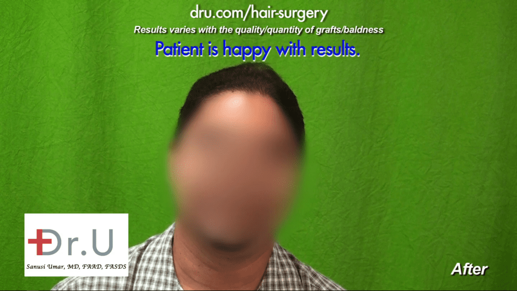 Shock Loss Around Strip Surgery Scars Restored by Dr.UGraft BHT: 600 beard DrUGraft restored this patient's hair,.