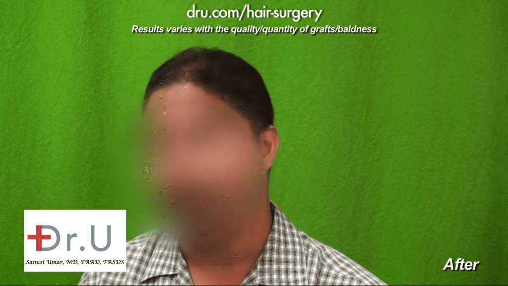 Dr. Umar repaired the damage from the patient's previous surgery, including the strip surgery scars for a natural look.