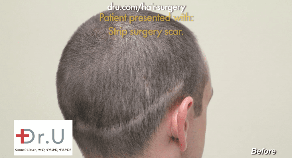 The patient's results from his previous strip surgery with a different surgeon. His scarring is very visible along the back of the scalp.