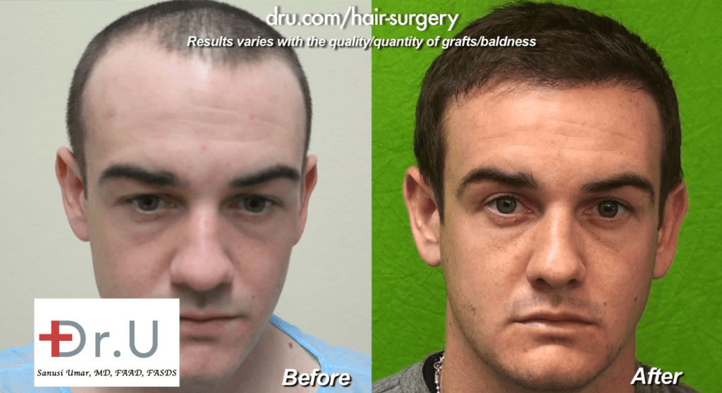 Hairline Restoration Before and After