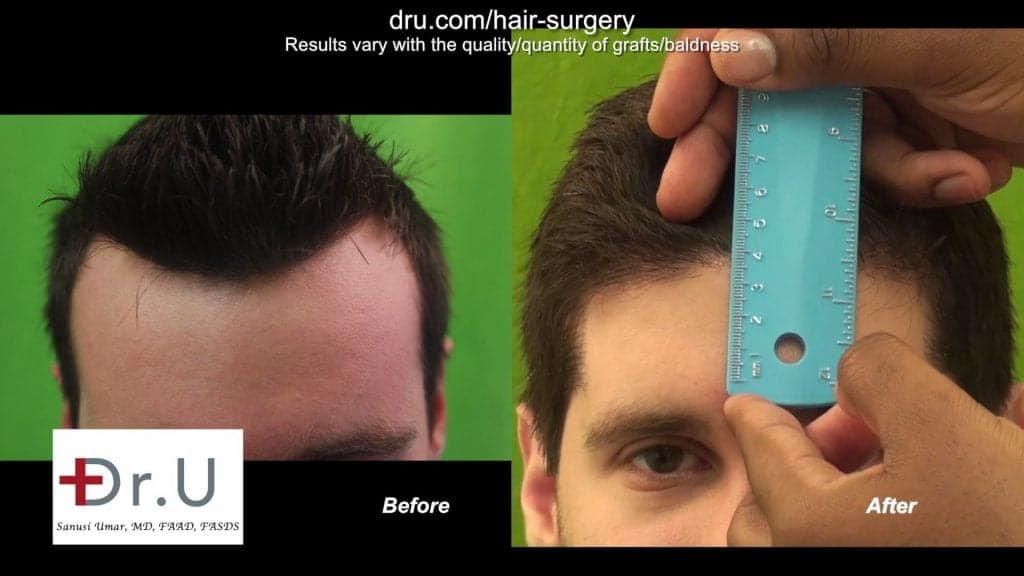 The best hair transplant clinic in the world demonstrates successful hair restoration that fills in patients' hairlines with new growth