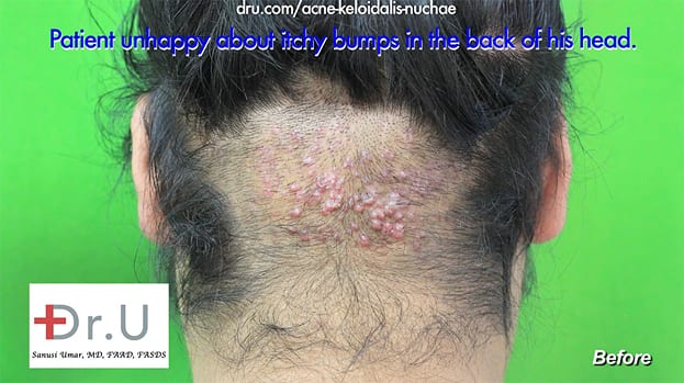 Razor Bumps Surgery