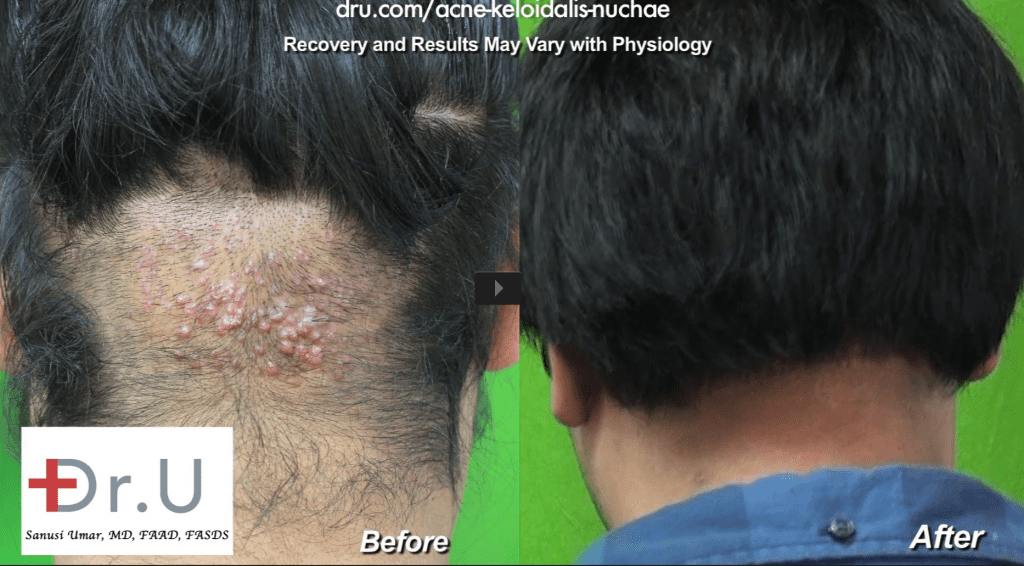Dr Umar AKN Back of Neck Razor Bumps removal surgery results