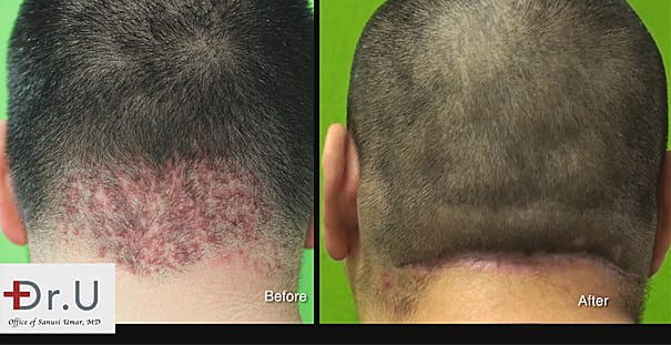 How do I get rid of a bump on the back of my neck and head? This Dr. U patient found the answer through AKN surgical removal.* How do I get rid of a bump on the back of my neck and head? This Dr. U patient found the answer through AKN surgical removal.*